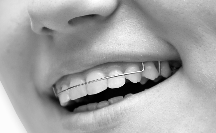 Retainers